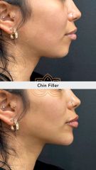 Acido hialuronico (Chin Filler) - Vive Spa Med