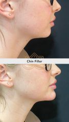 Acido hialuronico (Chin Filler) - Vive Spa Med