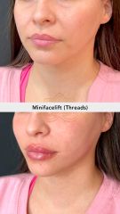 Hilos tensores (Minifacelift - threads) - Vive Spa Med