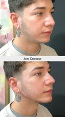 Acido hilauronico (Jaw Contour) - Vive Spa Med