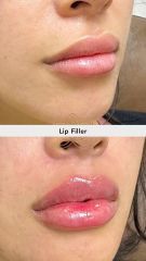 Aumento de labios (Lip Filler) - Vive Spa Med