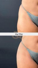 Acido hialuronico (Hip Filler) - Vive Spa Med