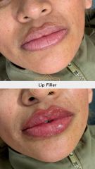 Aumento de labios (Lip Filler) - Vive Spa Med