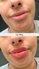 Aumento de labios (Lip Filler)  - Vive Spa Med