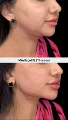 Hilos tensores (Minifacelift - threads) - Vive Spa Med