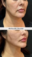 Hilos tensores (Minifacelift - threads) - Vive Spa Med