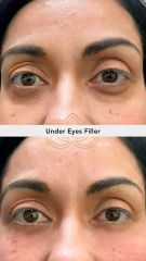 Acido hilauronico (Under Eyes Filler) - Vive Spa Med