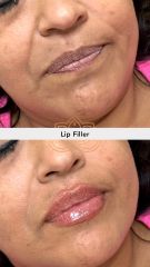 Aumento de labios (Lip Filler) - Vive Spa Med