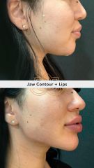 Acido hilauronico & aumento de labios (Jaw Contour & Lip Filler)