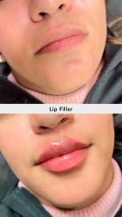 Aumento de labios (Lip Filler) - Vive Spa Med