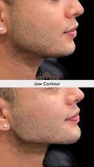 Acido hilauronico (Jaw Contour) - Vive Plastic Surgery