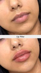 Aumento de labios (Lip Filler) - Vive Spa Med