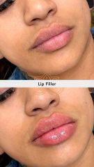 Aumento de labios (Lip Filler) - Vive Spa Med