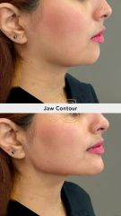 Acido hilauronico (Jaw Contour) - Vive Spa Med