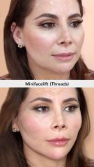 Hilos tensores (Minifacelift - threads) - Vive Spa Med