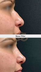 Acido hialuronico (Nose Filler) - Vive Spa Med