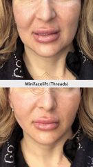 Hilos tensores (Minifacelift - threads) - Vive Spa Med