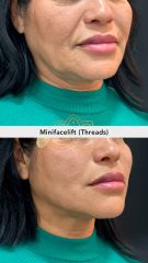 Hilos tensores (Minifacelift - threads) - Vive Spa Med