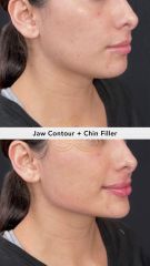 Acido hilauronico (Jaw Contour) - Vive Spa Med