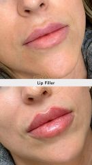 Aumento de labios (Lip Filler) - Vive Spa Med