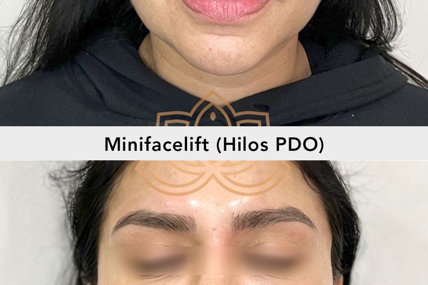 Hilos tensores antes y después - 871300