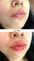 Aumento de labios (Lip Filler) - Vive Spa Med