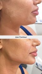 Acido hilauronico (Jaw Contour) - Vive Spa Med