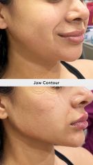 Acido hilauronico (Jaw Contour) - Vive Spa Med