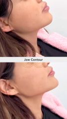 Acido hilauronico (Jaw Contour) - Vive Spa Med