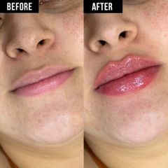 Aumento de labios  - Vive Spa Med