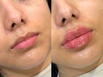 Aumento de labios antes y después - 872125