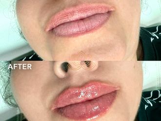 Aumento de labios antes y después - 872194