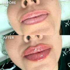 Aumento de labios - Vive Spa Med