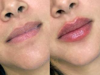 Aumento de labios antes y después - 872195