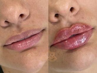 Aumento de labios antes y después - 872281