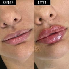 Aumento de labios  - Vive Spa Med