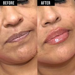 Aumento de labios (Lip Filler) - Vive Spa Med