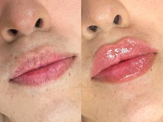 Aumento de labios antes y después - 872375