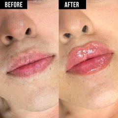 Aumento de labios - Vive Spa Med