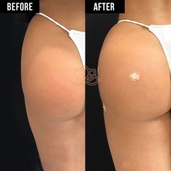 Acido hialuronico (Hip Filler) - Vive Spa Med