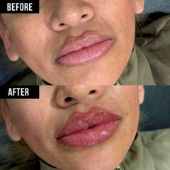 Aumento de labios (Lip Filler) - Vive Spa Med