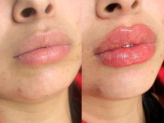 Aumento de labios antes y después - 872659