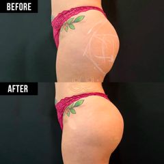 Aumento de Gluteos con Acido hialuronico - Vive Spa Med