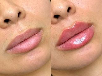 Aumento de labios antes y después - 872661