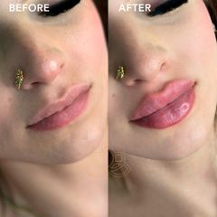 Aumento de labios (Lip Filler) - Vive Spa Med