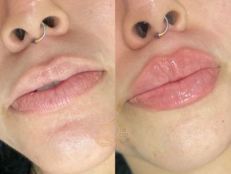 Aumento de labios antes y después - 873310