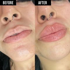 Aumento de labios (Lip Filler) - Vive Spa Med