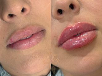 Aumento de labios antes y después - 873312