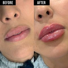 Aumento de labios (Lip Filler) - Vive Spa Med