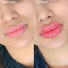 Aumento de labios (Lip Filler) - Vive Spa Med